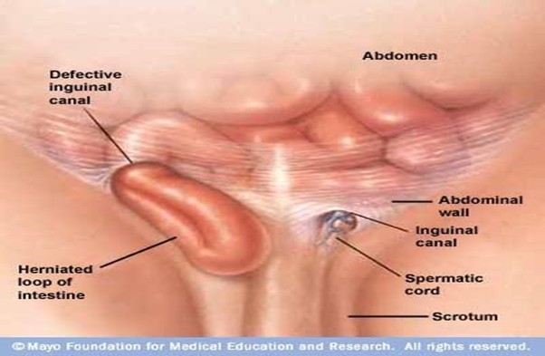 Hernia Repair Types